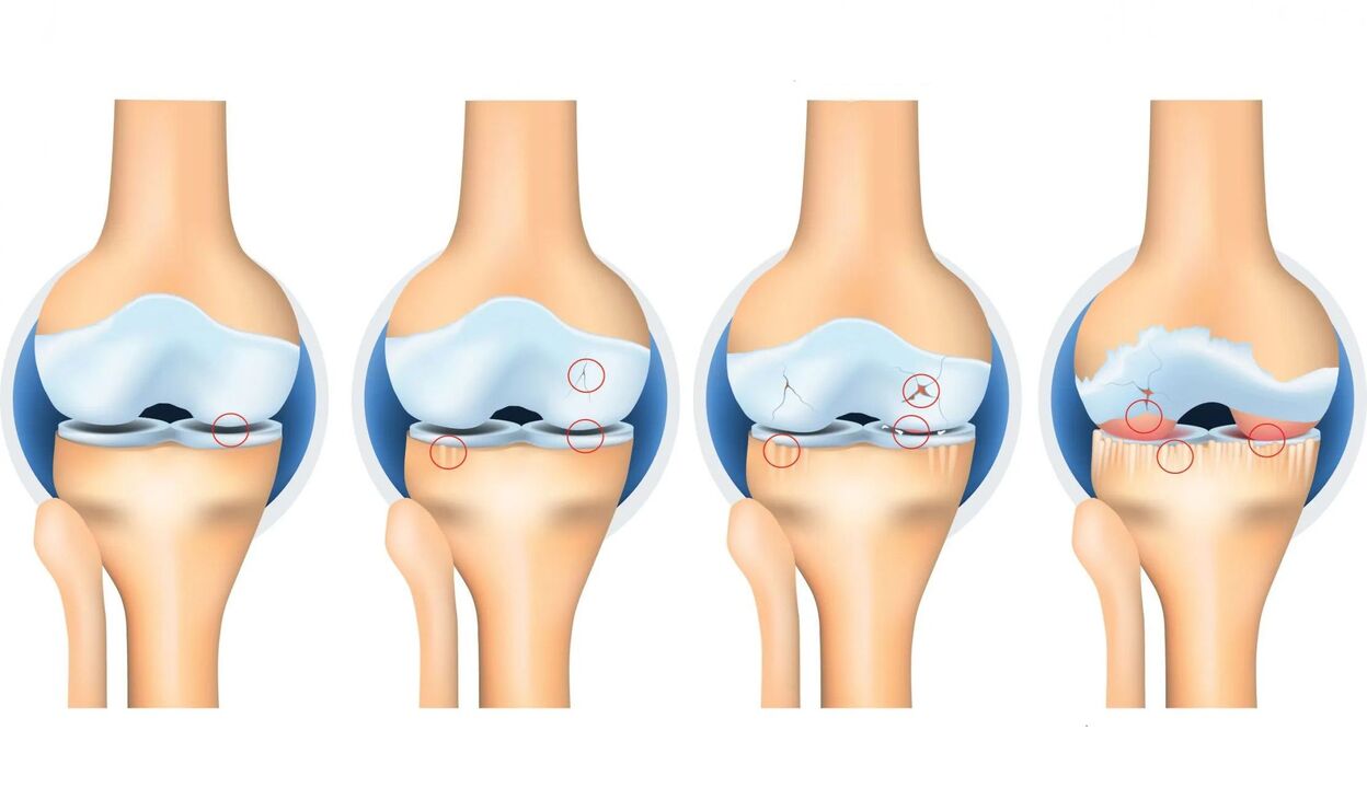 artrosis articular